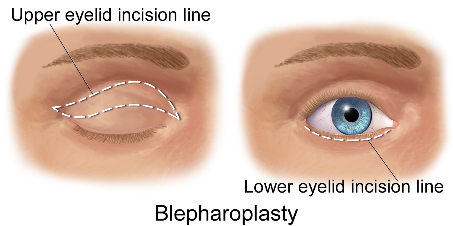 Illustration depicting incision lines for blepharoplasty
